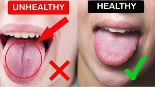 What Your Tongue Says About Your Health | What Your Tongue Reveal About Your Health