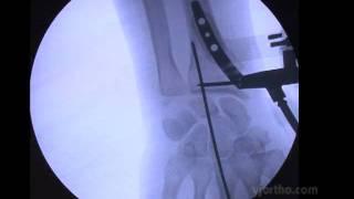 Hand and Wrist Surgery: Intramedullary Distal Radius Fixation