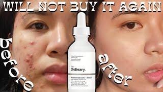 6 MONTHS OF THE ORDINARY NIACINAMIDE | I will stop  using it on my acne skin *not a clickbait* !!