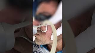 Get Flawless Skin with Fractional CO2 Laser Treatment | Skinaa Clinic #viral #ytshorts