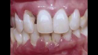 Periodontitis : Cure your Gum with Dr Mark Bonner