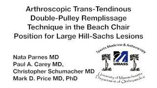 Arthroscopic Transtendinous Double-Pulley Remplissage Technique...