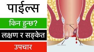 पाइल्सको घरेलु उपचार, piles in Nepali, payals ko gharelu upchar