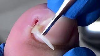 Pedicure Tutorial: Very deep ingrown nails, causing red, swollen and painful toes【Xue Yidao】