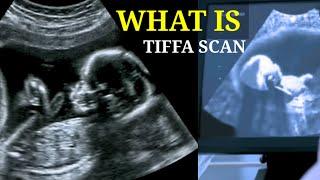 What is Tiffa || ultrasound || level 2 scan || Dr. Indu Yadav || #gynaecologist #ultrasound