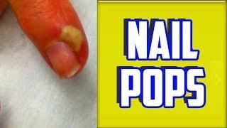 Top 4 Paronychia & Nail Infections of All Time!