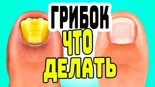 КАК ИЗБАВИТЬСЯ ОТ ГРИБКА НОГТЕЙ /  ЛЕЧЕНИЕ ГРИБКА НОГТЕЙ / НОГТЕВОЙ ГРИБОК