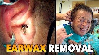 MASSIVE EARWAX REMOVAL! | Dr. Paul (feat. Maiya)