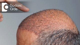 When will newly transplanted hair start to grow? - Dr. Niranjana Raj