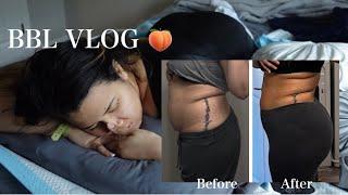 I GOT A BBL  Raw & Uncut first 3 days after a bbl & lipo 360 | BBL VLOG