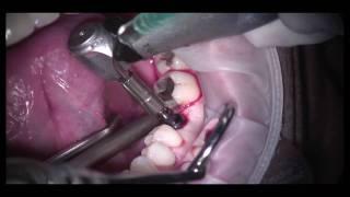 Guided Dental Implant Surgery: Part 2