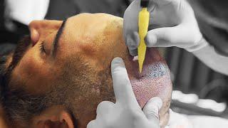 How Does It Work And What Is The Full Procedure? | DHI Hair Transplantation