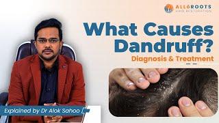 What causes dandruff? | Diagnosis and treatment| Explained by Dr. Alok Sahoo