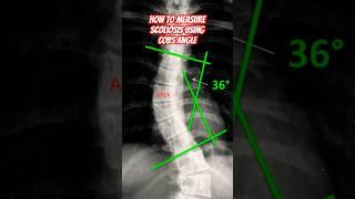 How to Measure Scoliosis #howto #shorts #doctor