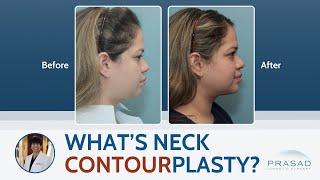 What is Neck Contourplasty? A Neck Lift for Any Age or Skin Type