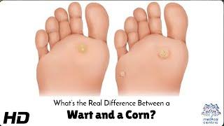 Wart vs Corn: Know the Difference!