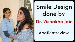 Patient From Florida (USA). Smile Design Done by Dr Vishakha Jain - Seraphic Dental Indore. Feedback