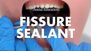 Placement of a Fissure Sealant