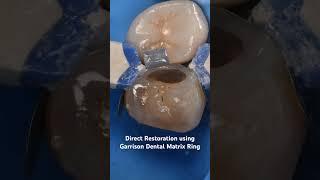 Direct Restoration using Garrison Dental Matrix Ring