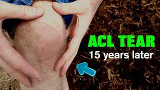 I tore my ACL years ago | Recovery WITHOUT surgery