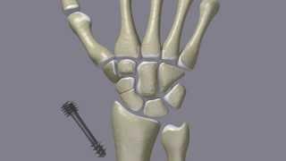 Scaphoid Fractures