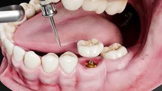 From Start to Finish: Understanding the Dental Implant Process