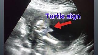 Posterior placenta with baby boy & girl | baby girl baby boy ultrasound pictures | 17 weeks pregnant