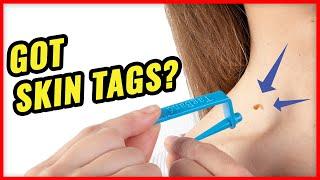 How to Remove Skin Tags Fast with TagBand