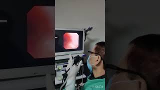 BAL sampling from right upper lobe of lung through Bronchoscopy in child ,Dr Dev Kumar Jha, M.D.