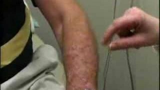 New Treatment For Psoriasis