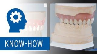 Ceramill FDS – Digital fabrication of single jaw dentures