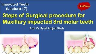 Impacted Maxillary third molar Extraction | Removal | Surgery |Syed Amjad Shah