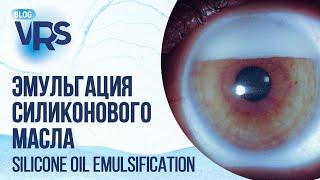 Эмульгация силиконогового масла и АГО | Silicone oil emulsification and glaucoma surgery