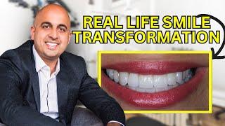 Real life story smile transformation with non prep veneers meaning ZERO damage to natural teeth.