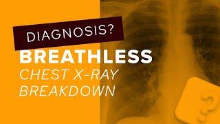 Chest X-Ray breakdown: assessing the lung apices