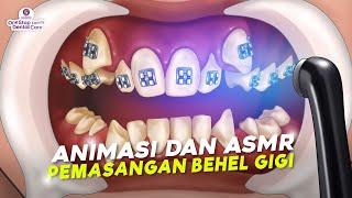 ANIMASI & ASMR PASANG BEHEL GIGI