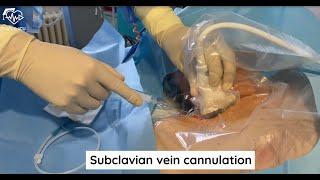 Subclavian vein cannulation