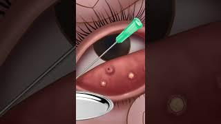 ASMR eye stone removal animation | Eyelid Sebum Extrusion Animation  | Meibomian Gland Cleaning
