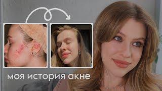 ДВАЖДЫ ПОБЕДИЛА АКНЕ / Моя история лечения и ухода / МНОГО ФОТО