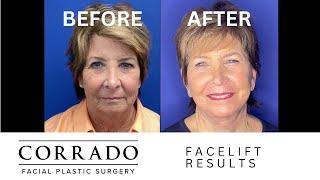 Facelift Journey: Before & After Pictures | Dr. Anthony Corrado