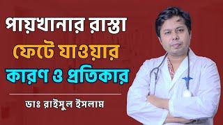 পায়খানার রাস্তা ফেটে যাওয়ার কারণ ও প্রতিকার  || Dr. Raisul Islam || Anal Fissure Treatment