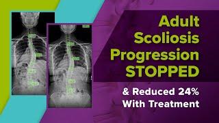 Adult Scoliosis Progression STOPPED & Reduced 24% With Treatment