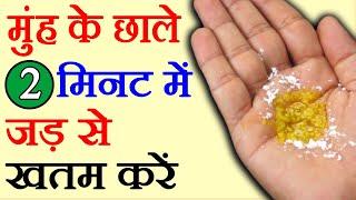 मुंह के छाले कैसे ठीक करें, 2 मिनट में muh ke chale kaise thik kare, How To Cure Mouth Ulcer