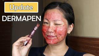 UPDATE DERMAPEN LAGI COBA PAKAI SERUM BARU SOLCARE