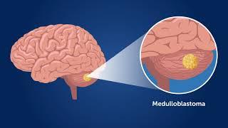 Late-Onset Complications of Childhood Medulloblastoma