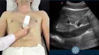 IVC Ultrasound | How to assess the IVC for volume status using ultrasound | Clarius Ultrasound