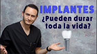 ¿Los Implantes Dentales duran toda la vida? | ¿Cuánto tiempo dura un implante dental?