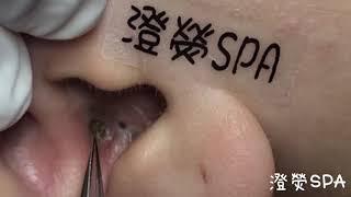 黑頭粉刺來了 More Ear Blackheads!  - 澄熒SPA