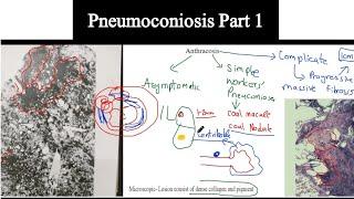 Pneumoconiosis Part 1- Histopathology of Anthracosis and Silicosis