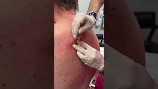 2 Giant Cysts, Iincised & Drained at Las Vegas Dermatology® by Dr. H.L. Greenberg